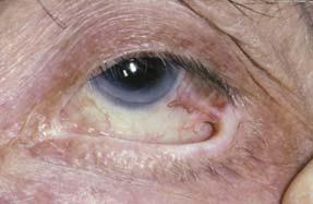surfaces Entropion Trichiasis Cornea keratinizes for self protection Blindness