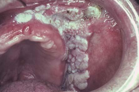 Verrucous Carcinoma 1 10% of all oral SCC A low grade variant of oral SCC More commonly seen in men Age 65 70 More frequently seen in patients who use smokeless tobacco Sites: Mandibular vestibule