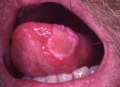 mucosa Can be seen on attached mucosa Tiny: 1 3mm Numerous: up to 100 at one time VERY painful Treatment of Aphthous Ulcers Rx: