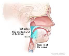 pharyngeal walls Pringle GA. The role of human papillomavirus in oral disease. Dent Clin North Am. 2014 Apr;58(2):385 99. **World Cancer Report 2014.