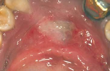 female with painful lesion floor of mouth