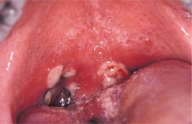 aphthae Behҫet s Syndrome 75% of the patients develop genital lesions vulva, vagina, glans