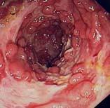 Distal small intestine Proximal colon Crohn s disease Estimated to affect 700,000 Americans M=F Age: 15 35.