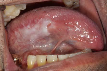 Leukoplakia White patch or plaque that cannot be characterized clinically or pathologically as any other disease entity A clinical term only Frequently has sharply defined borders May