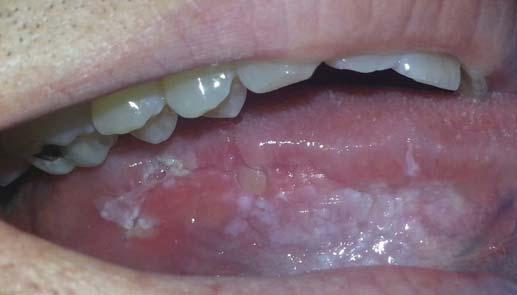 based on clinical appearance alone pebbly or verrucous lesions should be viewed with increased suspicion Malignant transformation potential 1 7% of thick leukoplakias 4 15% of granular