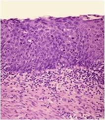 Carcinoma in situ (CIS) Histopathology dysplastic epithelial cells extend from the basal layer to the epithelial surface top to bottom change No invasion has