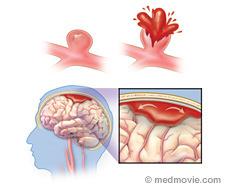 Causes for a Hemorrhagic Stroke A weakened blood vessel ruptures Aneurysms: Ballooning of a