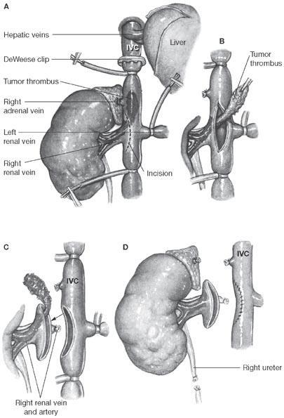 Principles of Surgery for Level I or II Tumor Thrombus Early control of renal artery Ligation of lumbar veins Clamps
