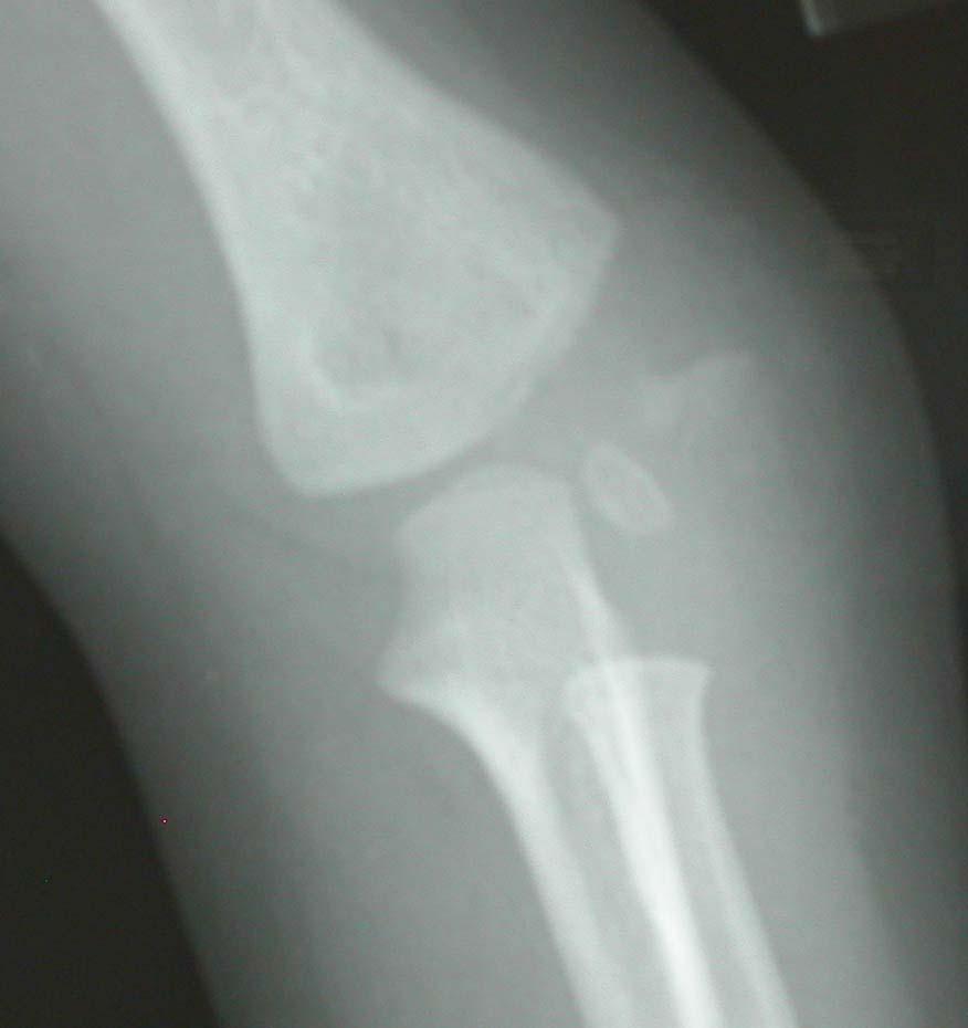 LATERAL CONDYLE FX TYPE I: MAY NEED AN OBLIQUE X-X RAY