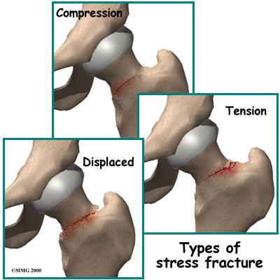 The stress fractures this article refers to are fatigue fractures.