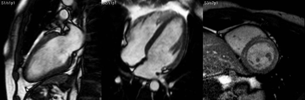 significant stenosis,