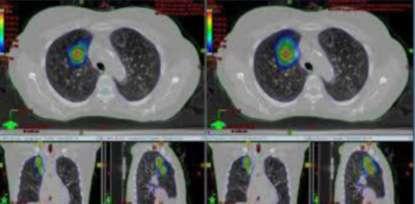 Lung cancer: patients live longer with Radiosurgery than with Surgery Chang JY et al.