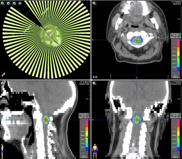 Stereotactic Radiotherapy Hospital of