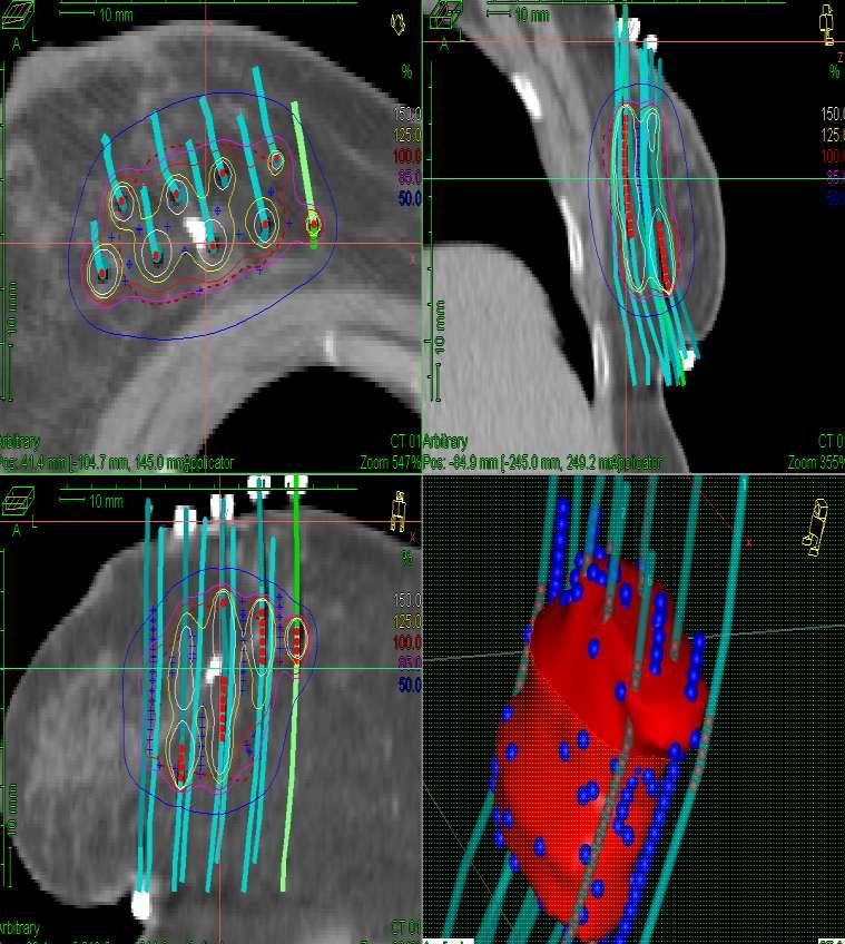 Breast cancer multicatheter interstitial brachytherapy treatment