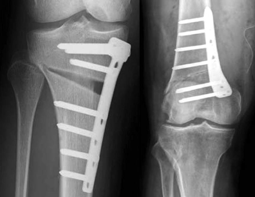 Periarticular knee osteotomy Turnberg Building Orthopaedics 0161