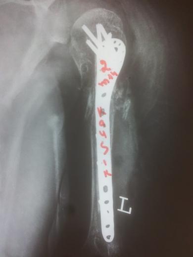 Preparation of the medullary canal: The humeral medullary canal was prepared to accept the bone graft.