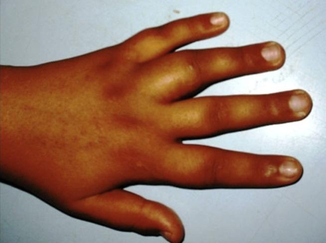 234 S. Baccari et al. Figure 1 Clinical view of the left hand showing a proximal swelling of the ring finger.