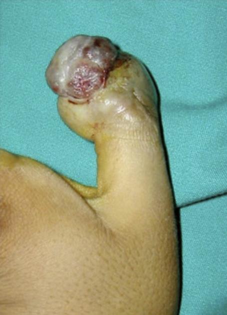 Ewing s sarcoma of the finger: Report of two cases and literature review 235 Figure 7 No local recurrence of the tumour after metacarpophalangeal disarticulation.