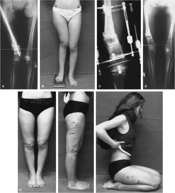 for 4 6 weeks. Figure 1 shows a patient (case 4) treated with these principles. FIGURE 1.