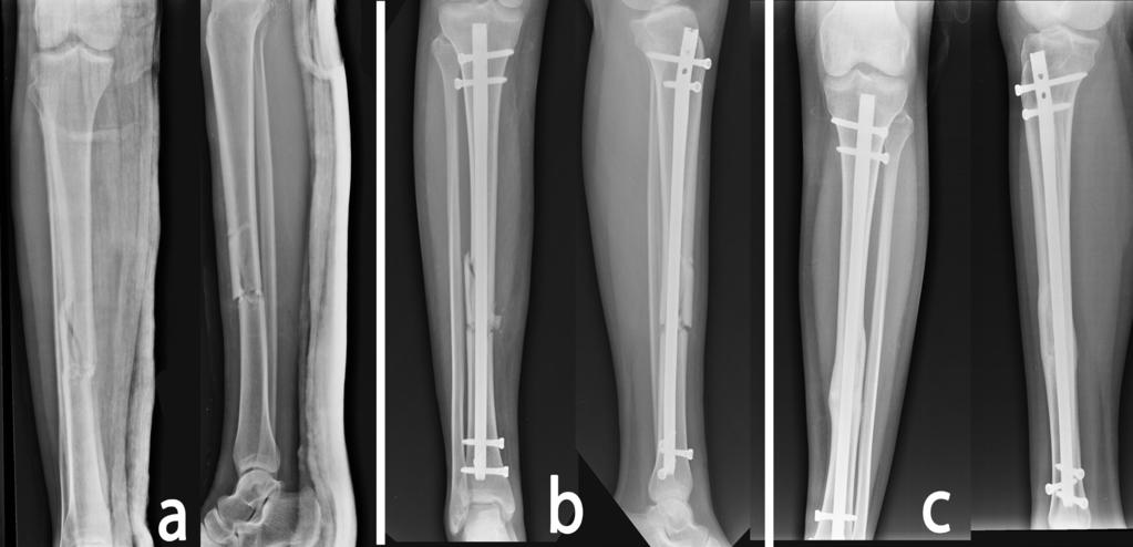 )35( Figure 2. Tibial shaft fracture treated with bi-planar distal locking (2 coronal and 1 sagittal screws). a) before surgery b) 3 weeks after surgery c) 3 months after surgery. Table 1.