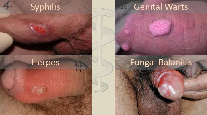 (swellings, discharge, grwths, rashes etc) Examinatin f the penis Inspect and palpate the ventral and drsal surfaces f the penis nting