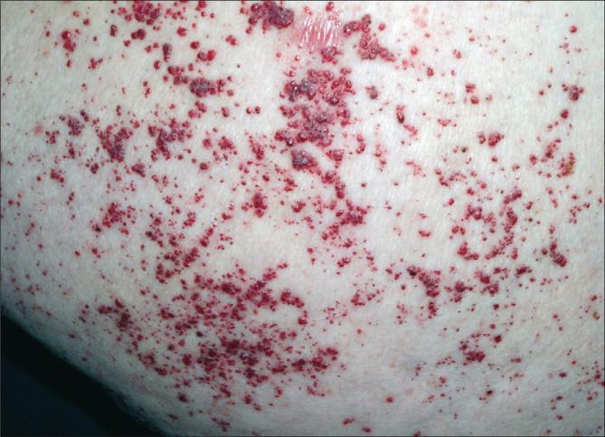 Fabry skin lesions Angiokeratoma corporis diffusum