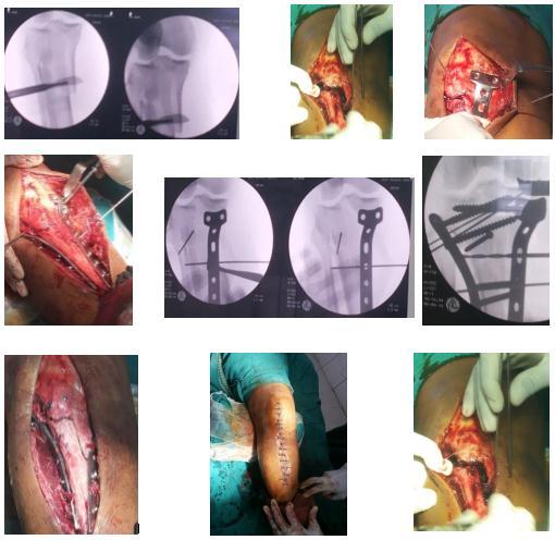 complications following attempted open reduction and internal fixation and poor bone quality and comminuted fracture patterns causing difficulty in achieving stable fixation.