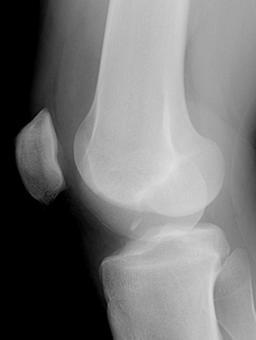 Continued Deep Sulcus Sign: Lateral femoral condylar