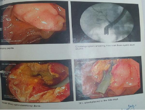 cuff of the gallbladder near the Hartmann s pouch, removing the rest of the gallbladder, in the manner [2] described by Lerner or Bornman and Terblanche [3] after removing all stones from the