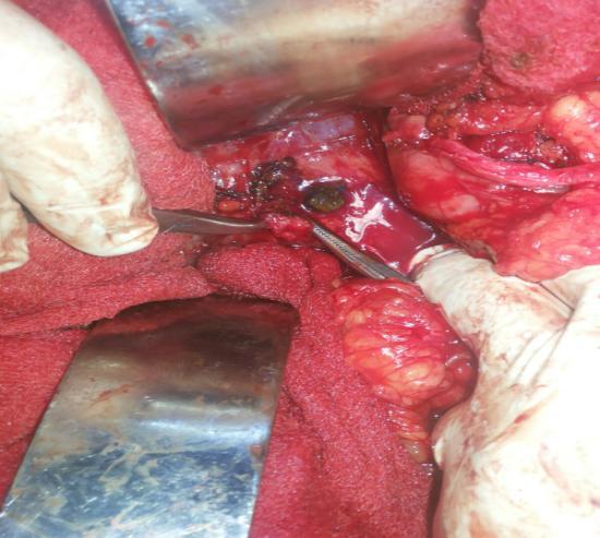 Cystic duct stump with calculus Discussion Imaging Anatomy The normal cystic duct connects the gall bladder to