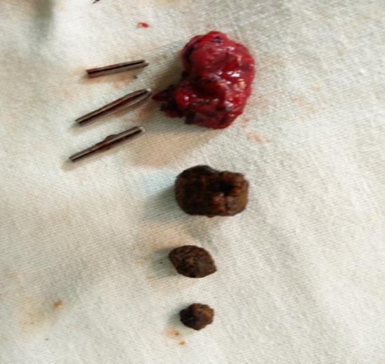 dissection and placement of clips during laparoscopic cholecystectomy.