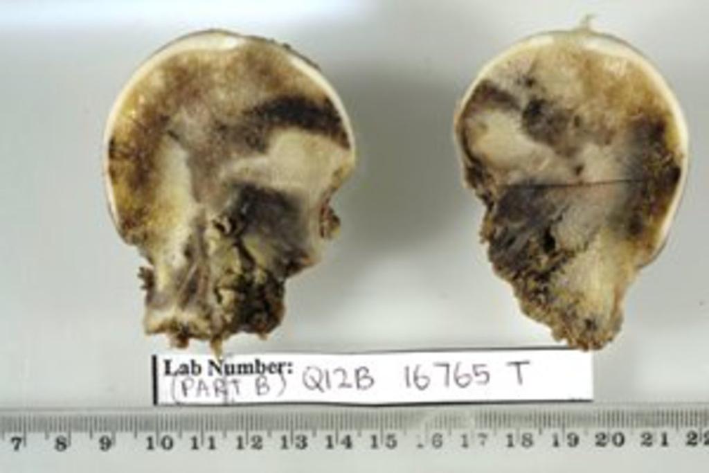 Fig. 7: Macroscopic specimen of the femoral head from the patient in Fig. 6.