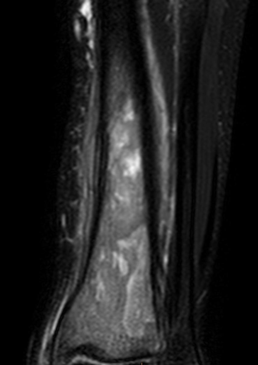 Fig. 8: 18-year-old male with NHL of the distal tibia.