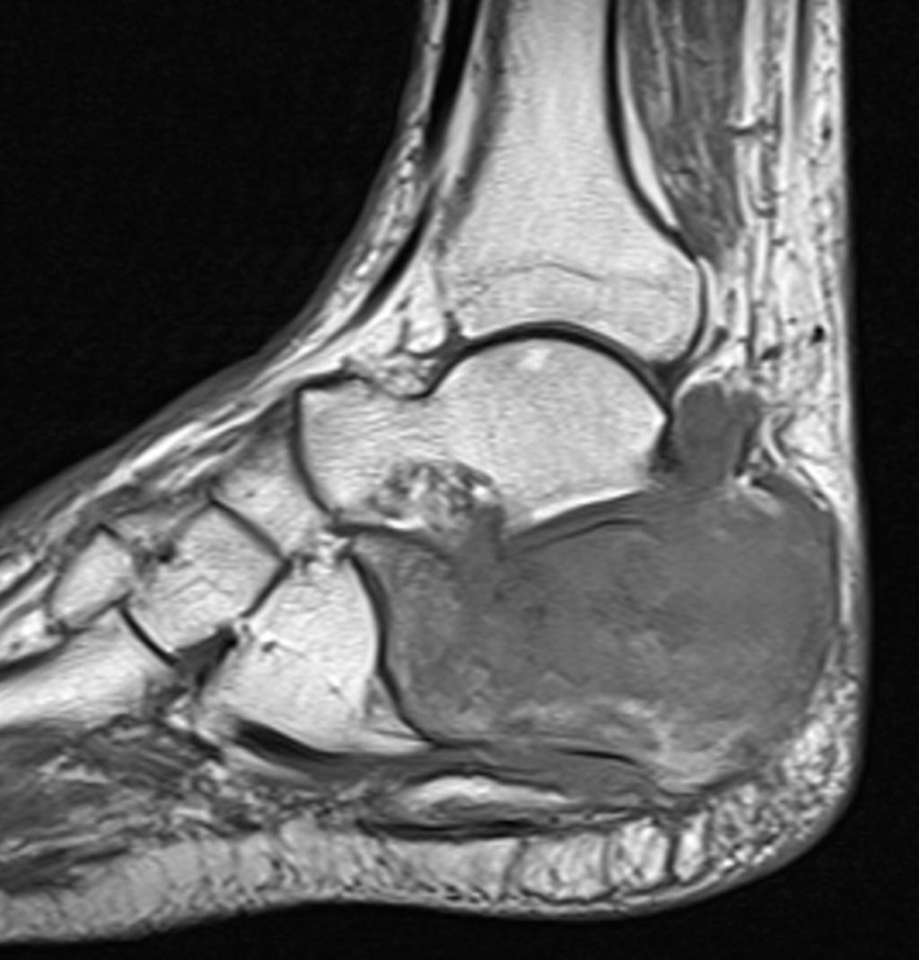 Fig. 11: 74-year-old male with NHL of the calcaneus.
