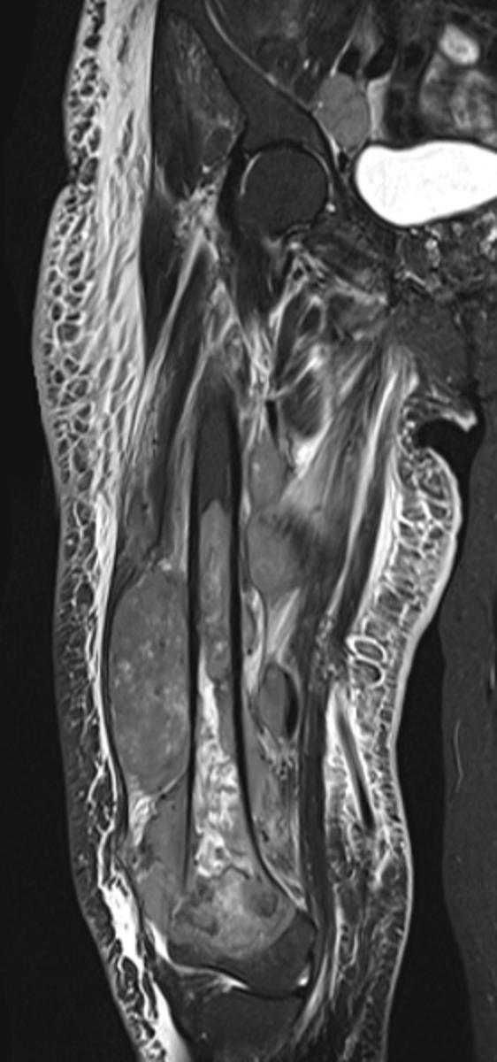 Fig. 15: Same patient as Fig. 14. Coronal STIR image depicts a long segment of heterogeneous marrow replacement within the distal femur with multicompartmental soft tissue involvement.