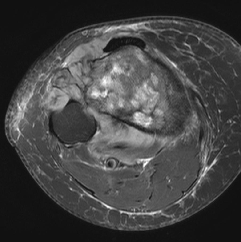 Fig. 16: 81-year-old female with NHL of the proximal calf. Axial fat-suppressed T2weighted image shows a mixed mosaic pattern of marrow replacement.