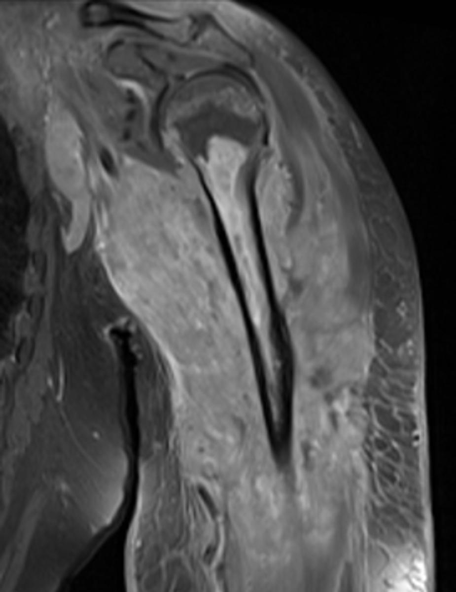 Fig. 17: 60-year-old female with NHL of the arm.