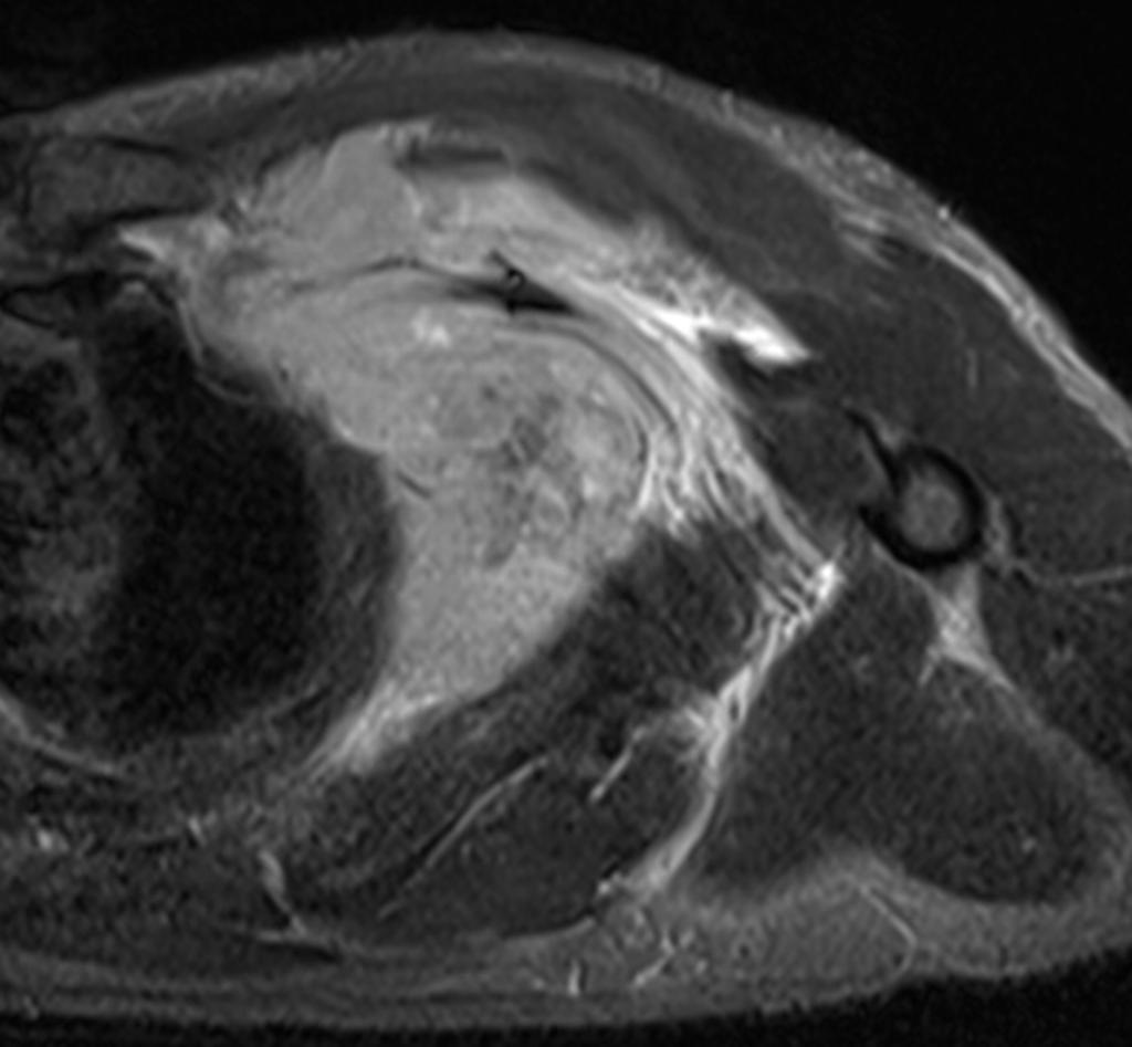 Fig. 19: 60-year-old male with NHL of the chest wall.