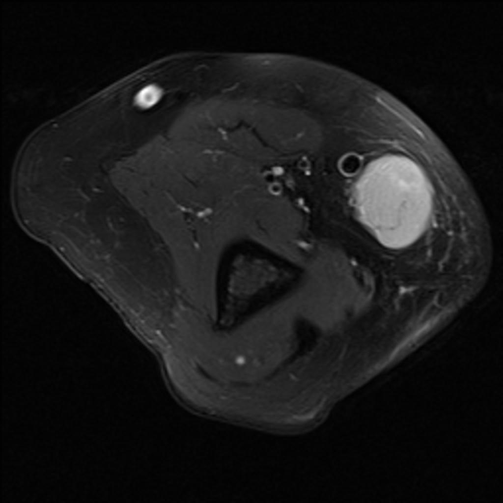 Fig. 22: Same patient as Fig. 21. Axial fat-suppressed T2-weighted image.