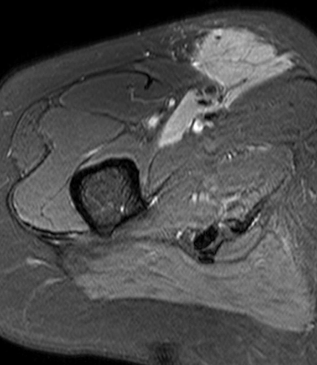 Fig. 23: 56-year-old female presenting with an anterior thigh mass.