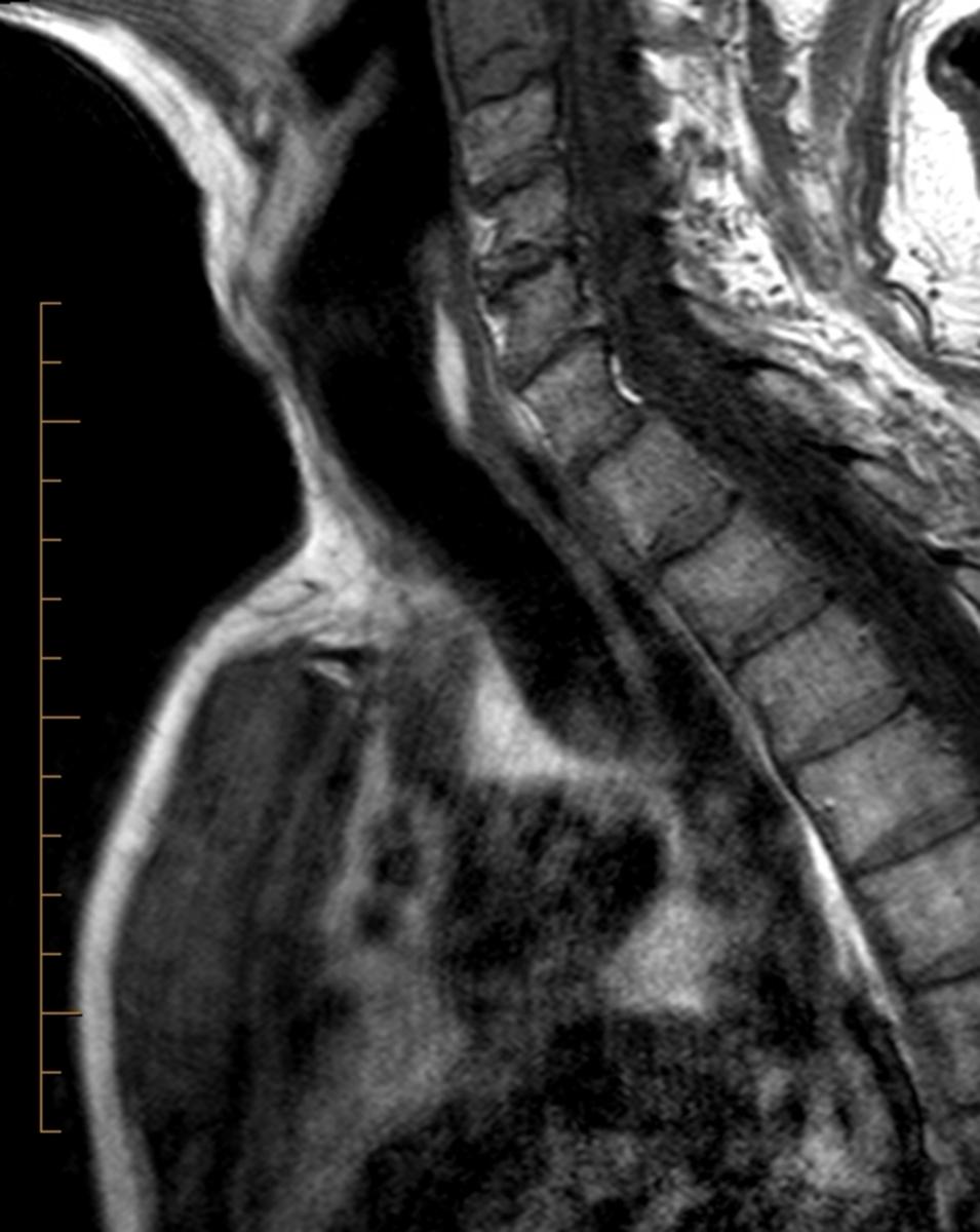 Fig. 26: 87-year-old male presenting with anterior chest pain and swelling.