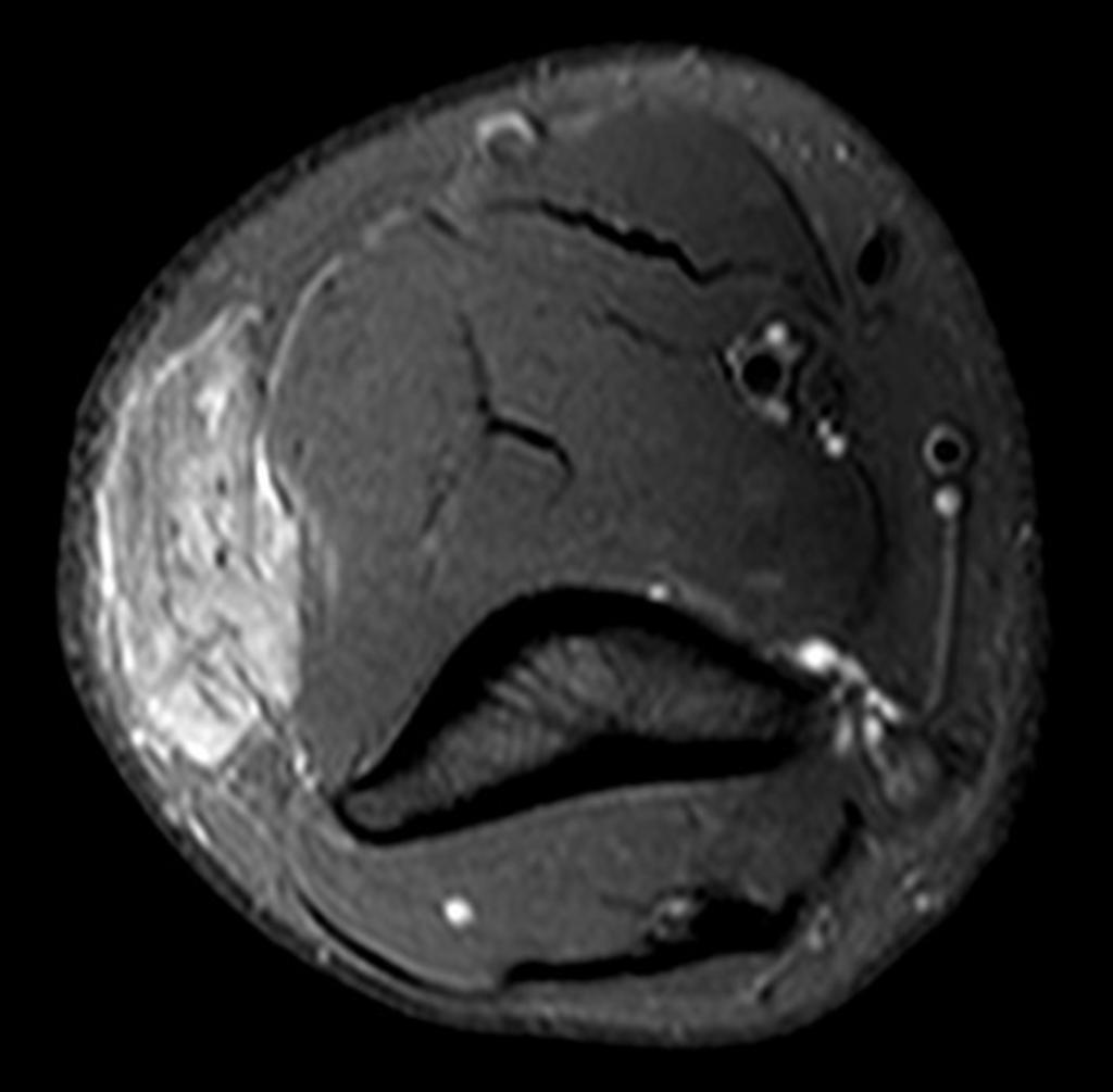 Fig. 28: 58-year-old male presenting with a mass near the elbow.