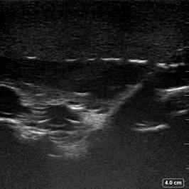 acquisition to perform Infraclavicular brachial plexus and PEC blocks Teaches ultrasound anatomy patterns recognition and needle-eye coordination Pectoralis major and minor