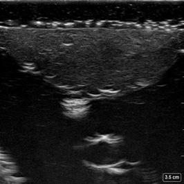 popliteal sciatic and IPAC blocks Teaches ultrasound anatomy pattern for sciatic nerve sheath, and needle-eye coordination Popliteal artery and vein; Common peroneal nerve; Tibial nerve;