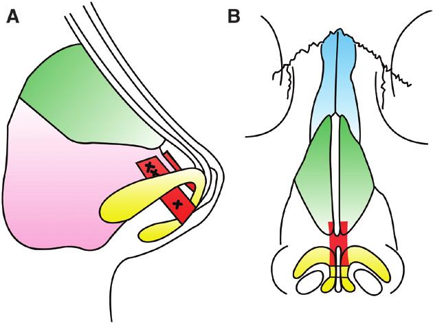 The height of the dorsum was adjusted according to the newly formed nasal tip with a slight concave contour in females and a straight profile in males.