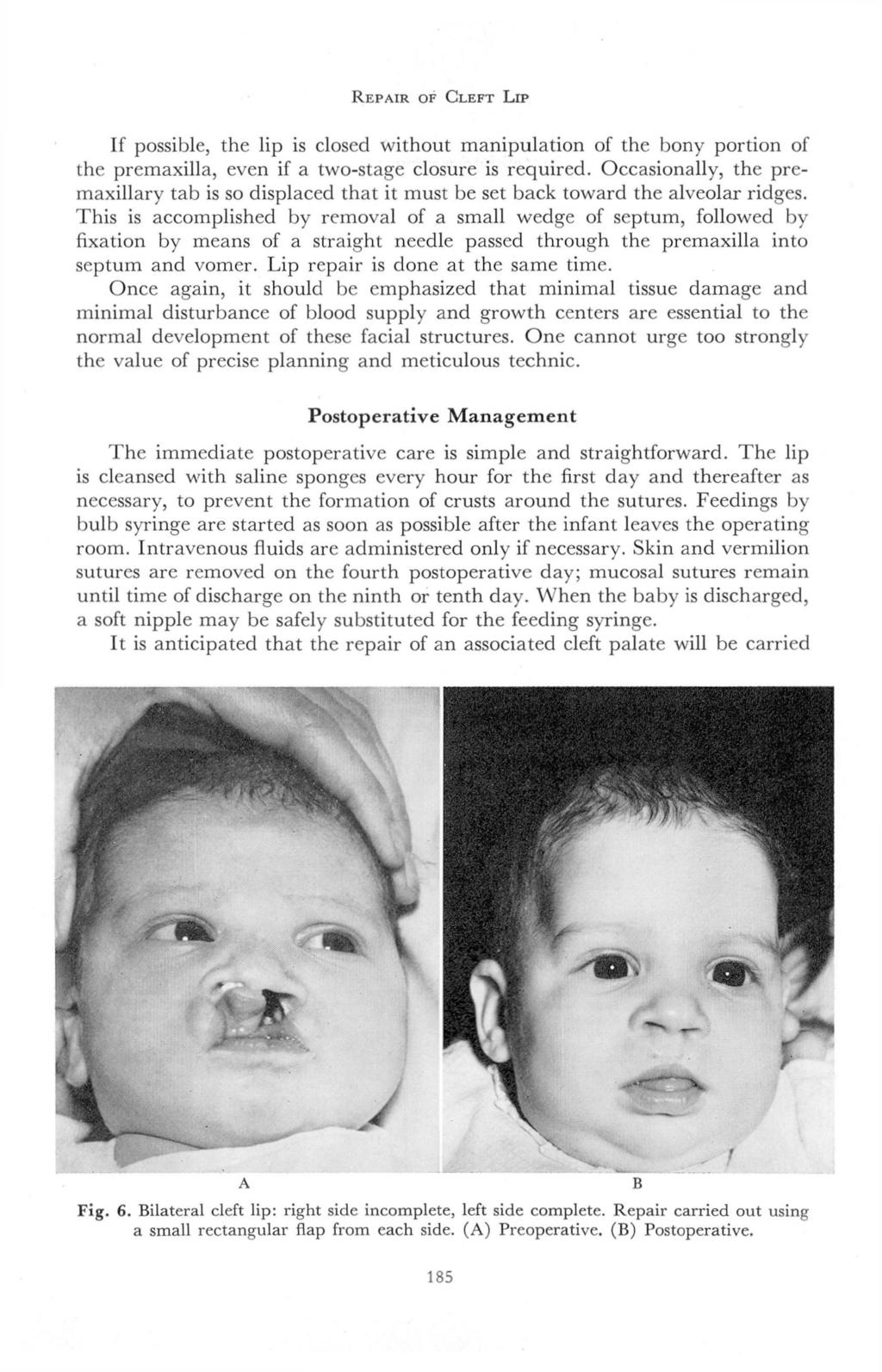 REPAIR OF CLEFT LIP If possible, the lip is closed without manipulation of the bony portion of the premaxilla, even if a two-stage closure is required.