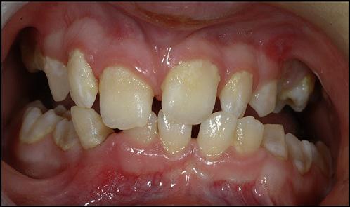 338 Rizkallah et al Dental evaluations, extraoral and intraoral photographs, and alginate impressions for study models were taken.