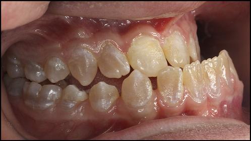 The plaster models were trimmed according to the American Board of Orthodontics standards and placed into occlusion.