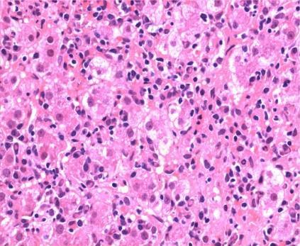 fibrosis Large duct SC Lympho-plasmacytic