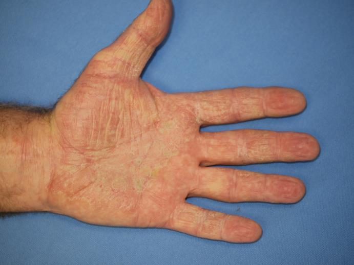 BSA Body surface area Patient s hand is 1% BSA Mild psoriasis: